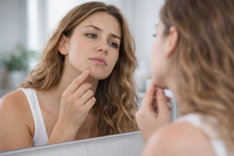 akne od stresa ► Herbalia akne od stresa