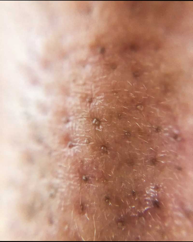 mitiseri na nosu simptomi ► Herbalia mitiseri na nosu simptomi