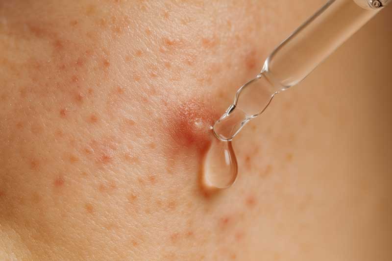 serum protiv akni ► Herbalia serum protiv akni