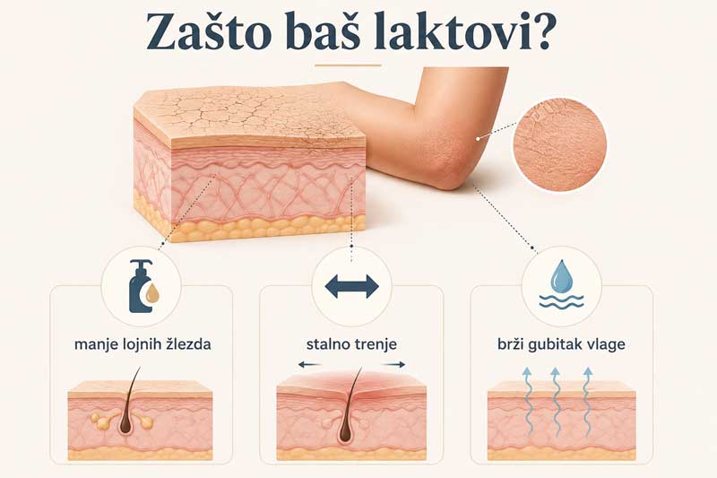 uzroci suvih laktova